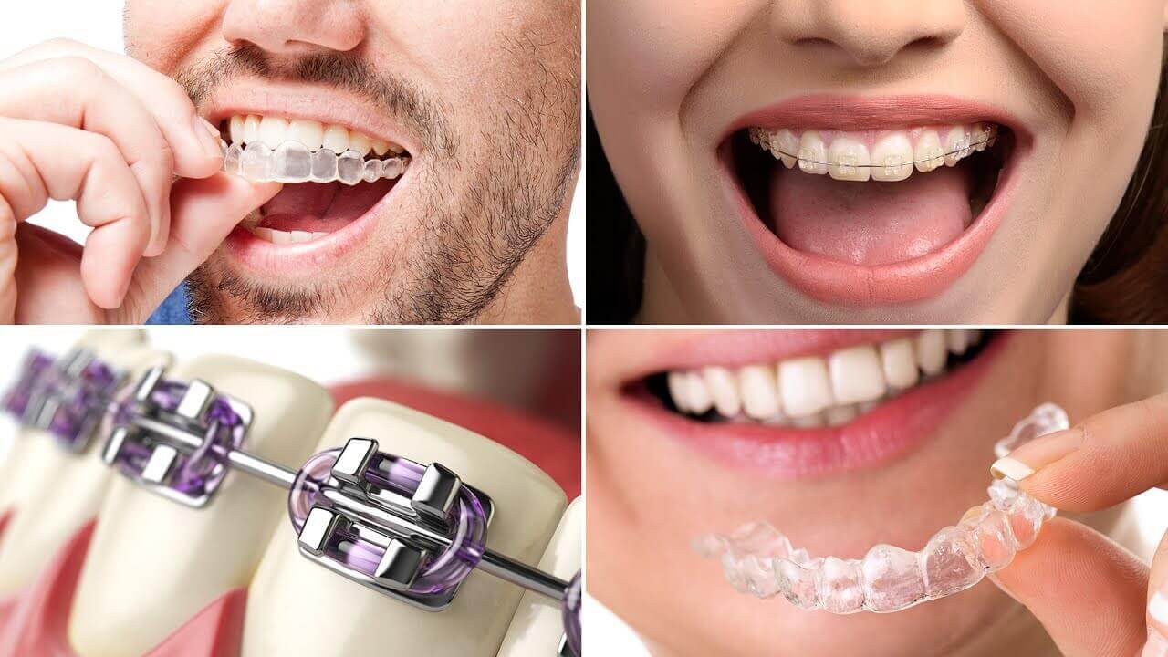 types of braces 